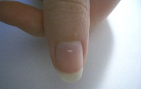 El emplasto de la psoriasis la piel tierna las revocaciones el precio