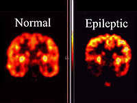 epilepsia