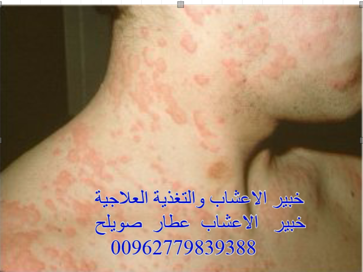 الحكة الجلدية