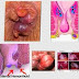 Gejala Wasir Berdarah thumbnail