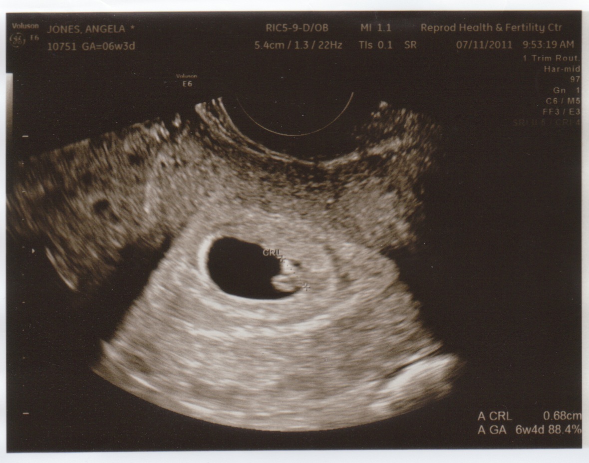 Sonogram 2 Weeks