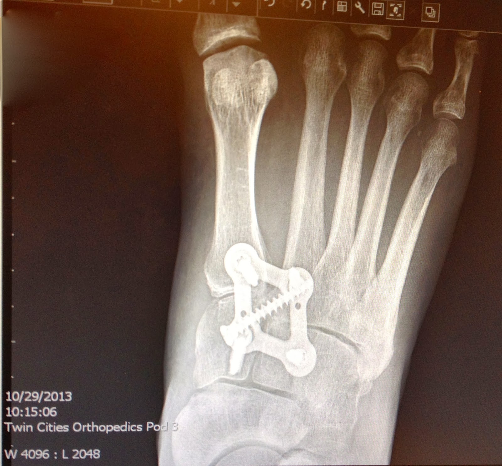 After LisFranc Surgery 2013