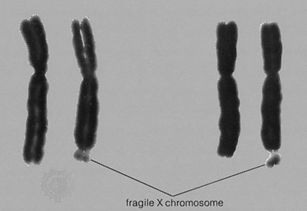 a study on fragile x syndrome A new study led by scientists at the new tsri study shows early brain changes in fragile x new tsri study shows early brain changes in fragile x syndrome. a study on fragile x syndrome A new study led by scientists at the new tsri study shows early brain changes in fragile x new tsri study shows early brain changes in fragile x syndrome.