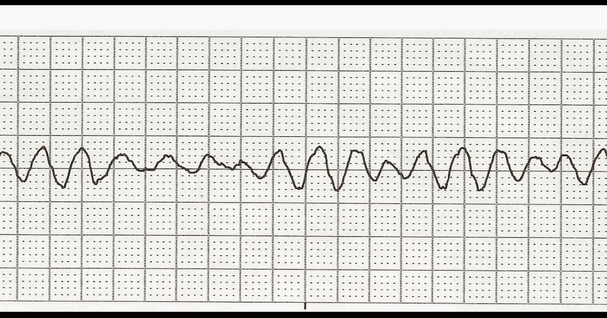 Float Nurse: Practice EKG Strips 422