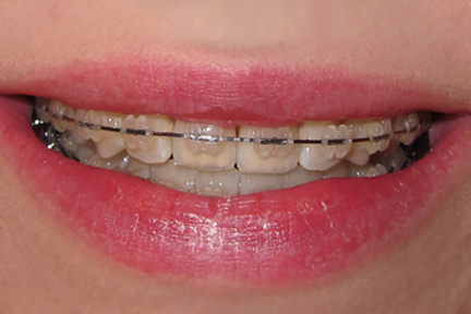 2 Months, 16 Days Malocclusion Class Ii. 2 Months, 16 Days