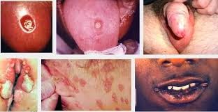 sipilis sipilis