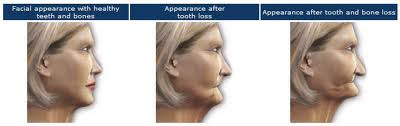 Dental implants in Houston Dental implants in Houston