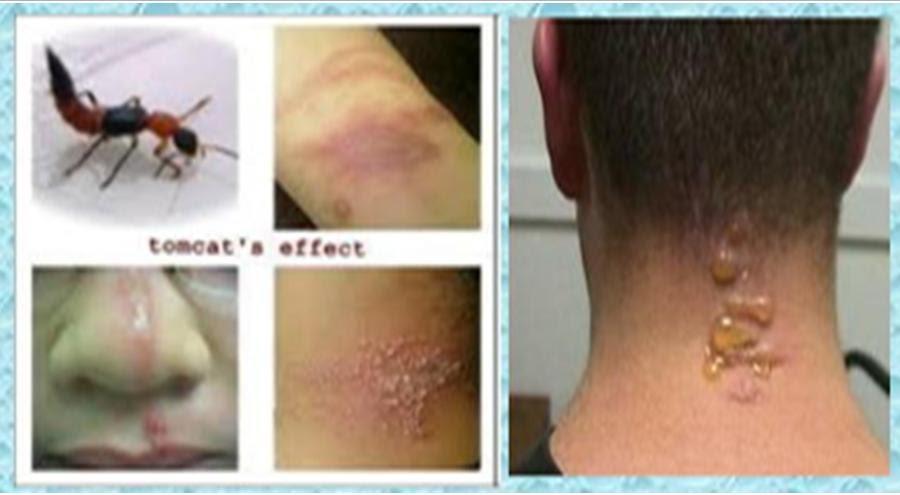 Obat antiinflamasi oral