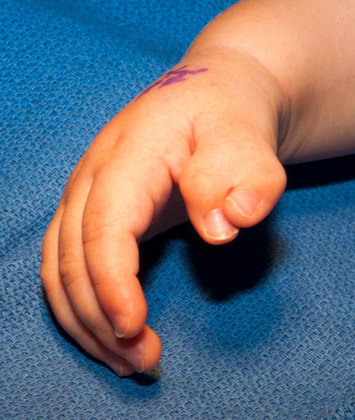 The Extra Thumb Congenital Hand and Arm Differences Washington