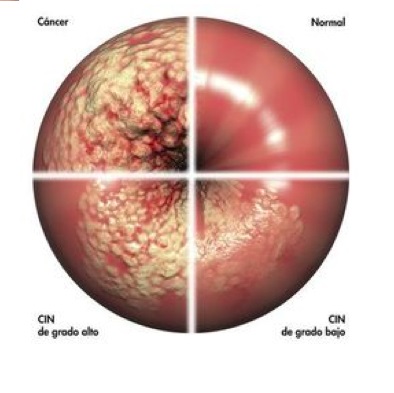 naked girls of finland vaginal lesion stages hpv
