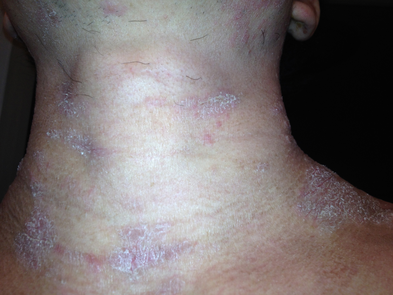 アトピー写真ブログ 首と後頭部