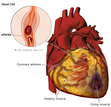 nursing care plan for myocardial infarction