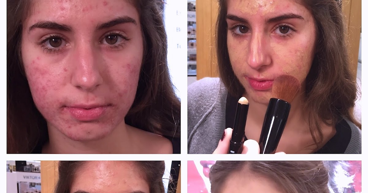 maquillaje antes y despues acne