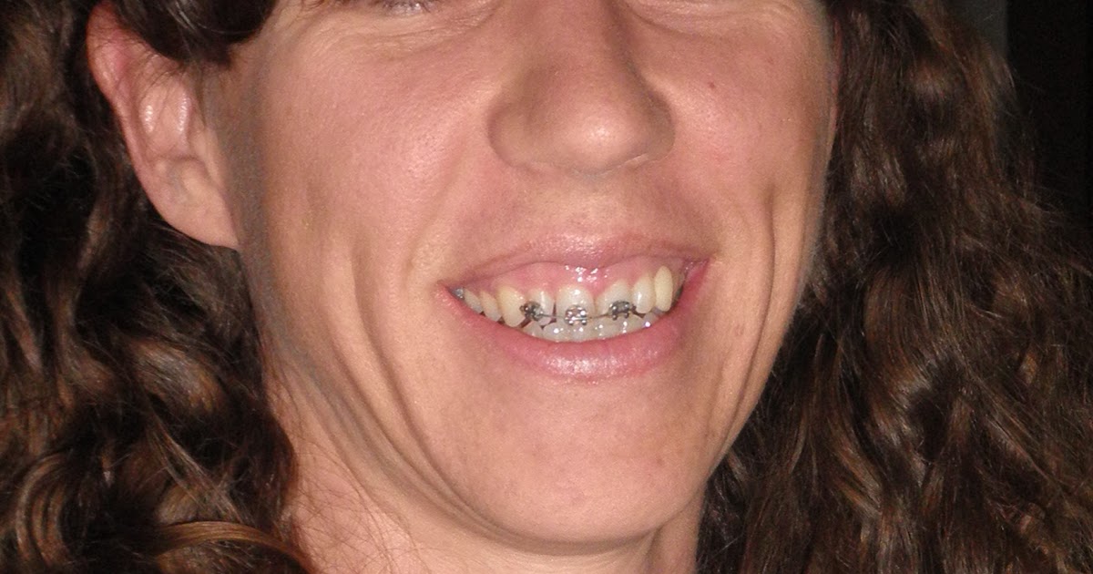 Where in the World are the Schlafmanns? Metalmouth at 34