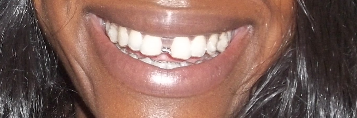 Getting Rid Of My Gap With Invisalign Tray 3