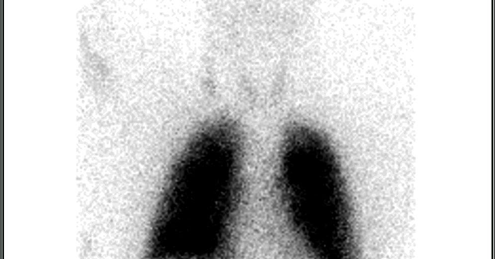 Nuclear Medicine Technology Program Perfusion Lung Scan Artifact