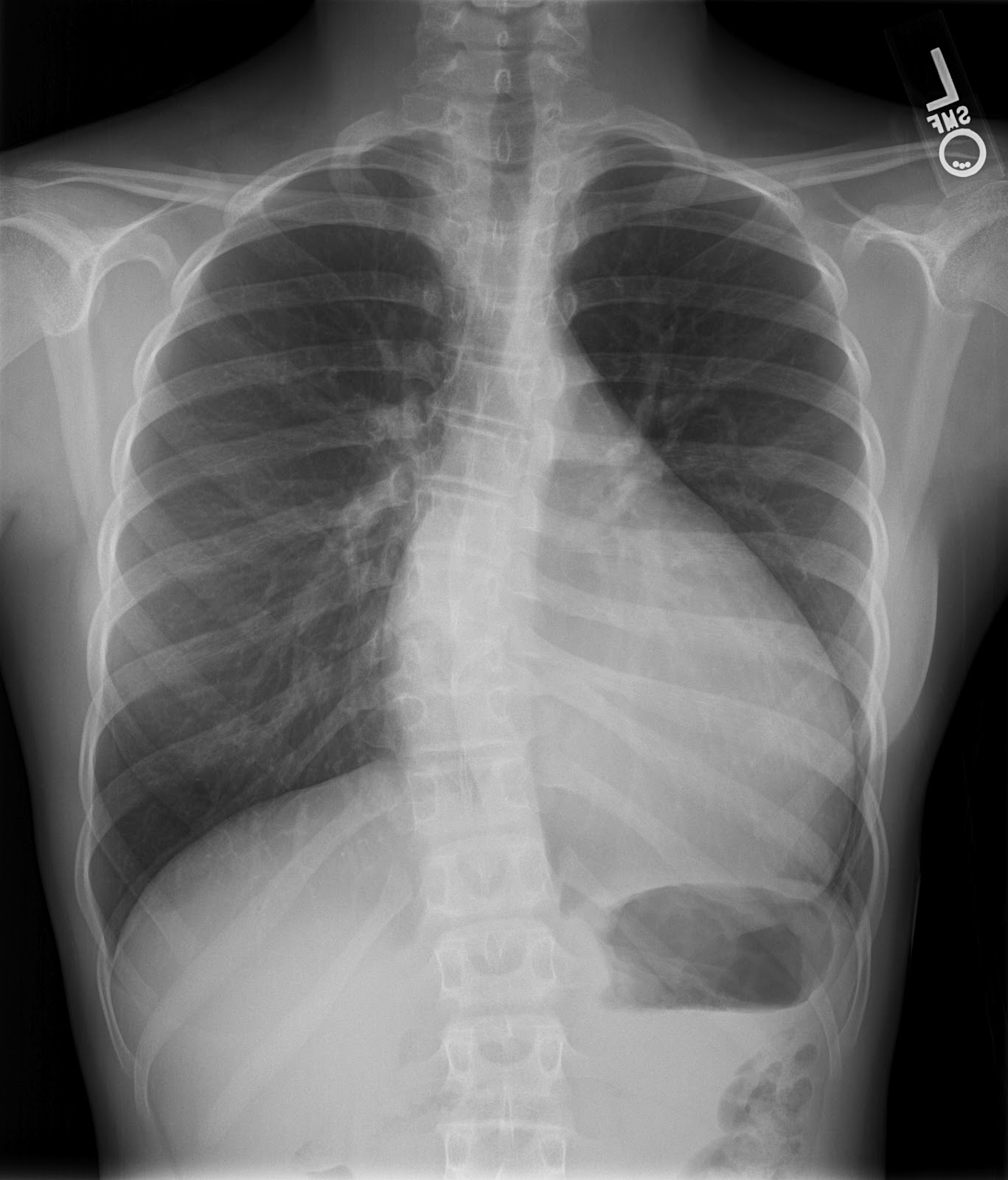 Dr. Smith's ECG Blog Exertional Chest pain and Near Syncope in a Young