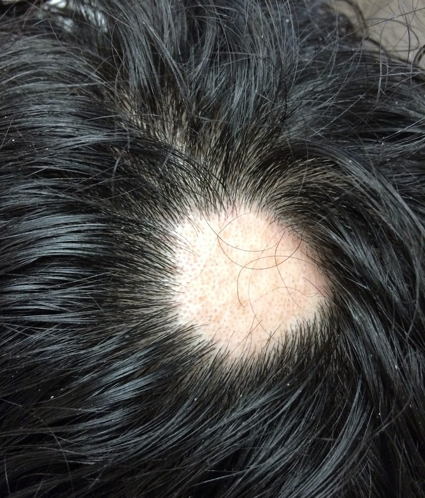 Hair Fall Round Patch