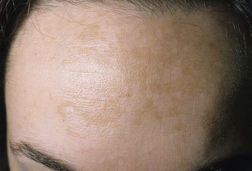 forehead patch scaly skin