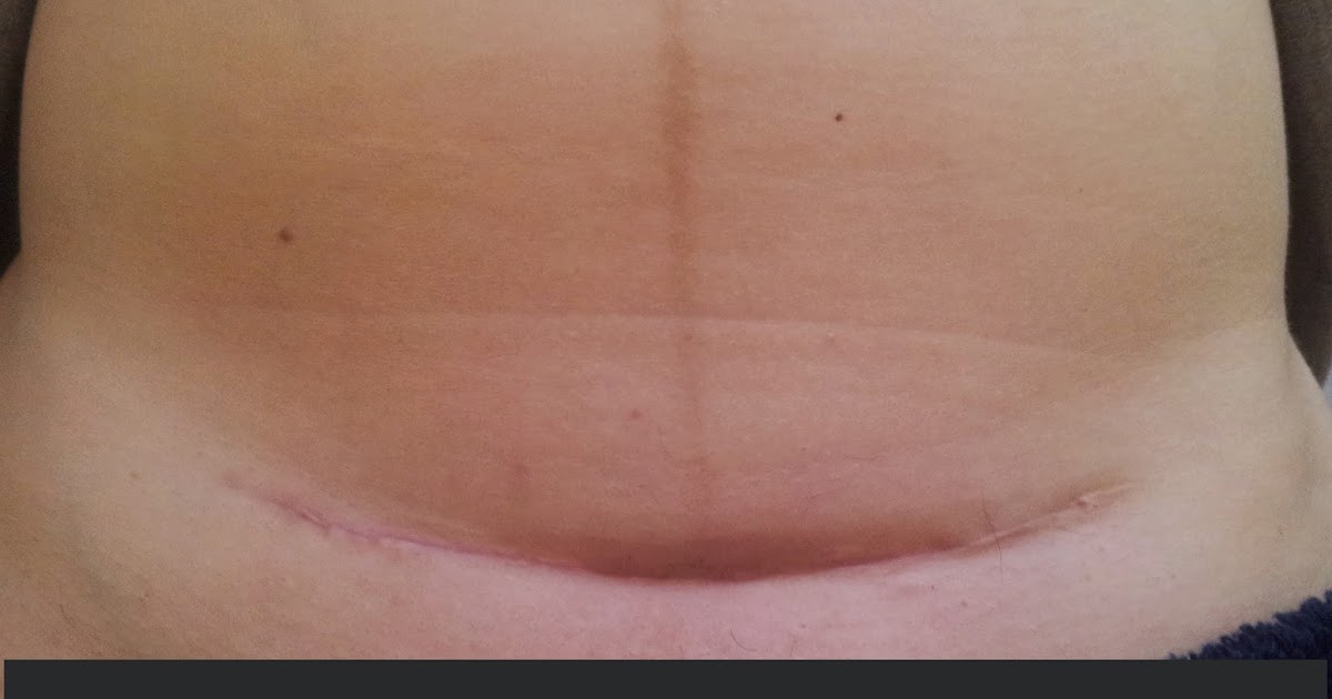 ASPECTO DE UNA CICATRIZ DE CESÁREA ANTES Y DESPUÉS DEL ...