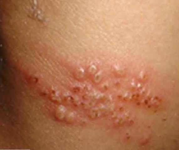 Various Primary Genital Herpes Symptom in Men and Women