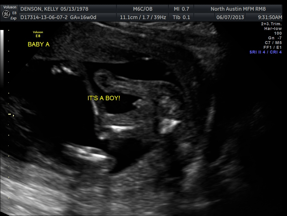 The Texas Trio A Triplet Pregnancy Blog 16 week ultrasound pics