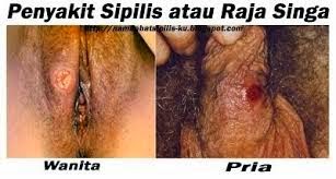 Penyakit Sipilis Pria Dan Wanita Penyakit Sipilis Pria Dan Wanita