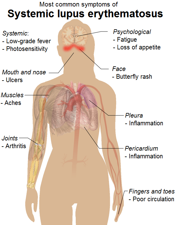 Systemic Lupus Erythematosus And Its Effects On