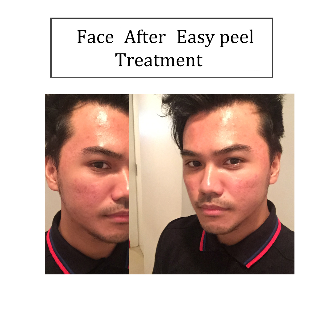 How effective is the glycolic peeling procedure How effective is the glycolic peeling procedure