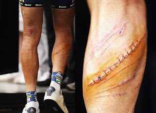 Johnny Hoogerland - szwy na nodze po wypadku podczas Tour de France 2011
