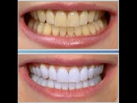تبيض الاسنان بالخلطات الطبيعية