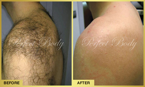 Laser Skin Tightening Long Island Laser Skin Tightening Long Island
