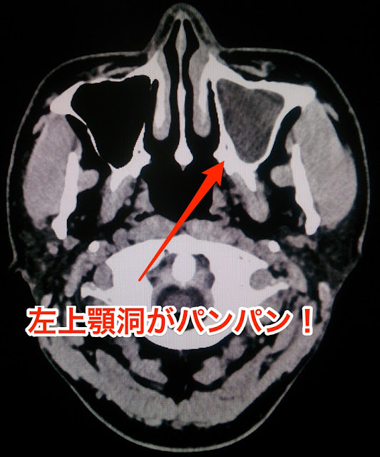 左上顎洞の副鼻腔炎