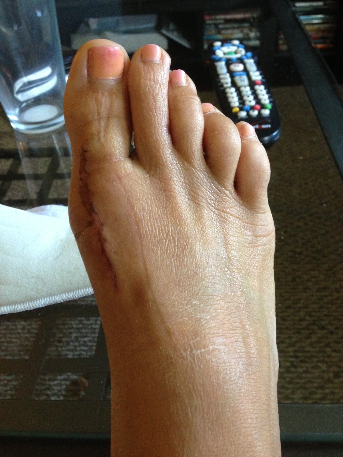 Two Effective Methods Epsom Salts & Neosporin Bunions Be Gone