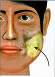 Herbal Atasi Penyakit Tumor Rahang | Apotek Herbals