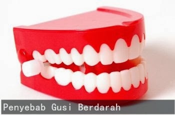 penyebab gusi berdarah penyebab gusi berdarah