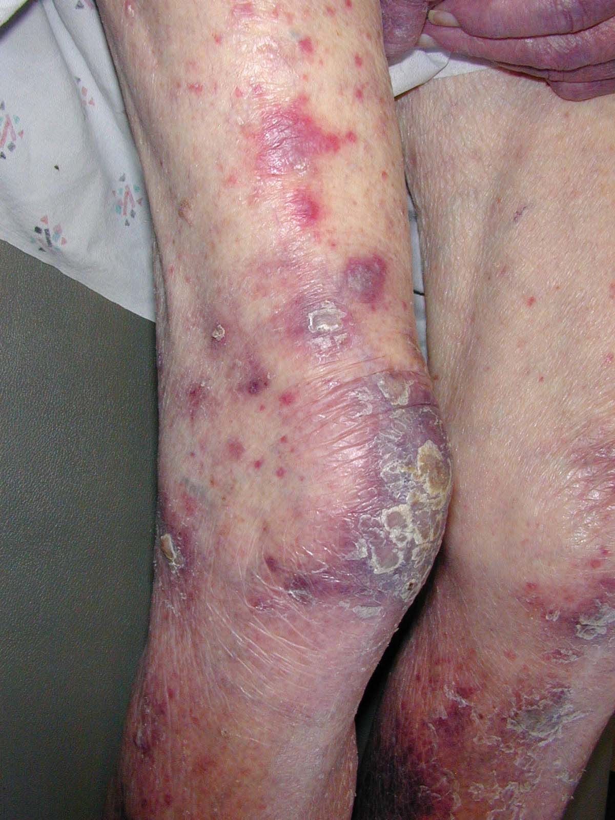 leukemia causes treatment and symptoms Acute myeloid leukemia (aml) is a deadly form of cancer which develops in the blood and in the bone marrow this disease specifically affects the white blood cells in your body and causes them to . leukemia causes treatment and symptoms Acute myeloid leukemia (aml) is a deadly form of cancer which develops in the blood and in the bone marrow this disease specifically affects the white blood cells in your body and causes them to .