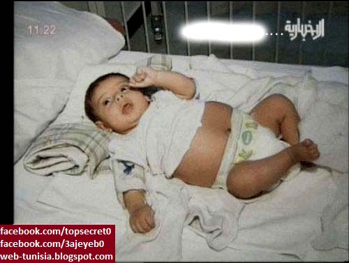 طفل يبلغ من العمر سنه يحمل داخل بطنه جنين (( سبحان الله )) بالصور والبراهين Tefl+2