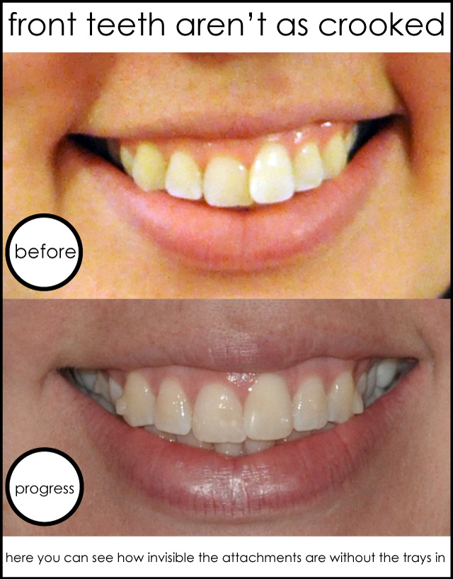 does teeth braces take stay progress smile uhighlsu fc2 web