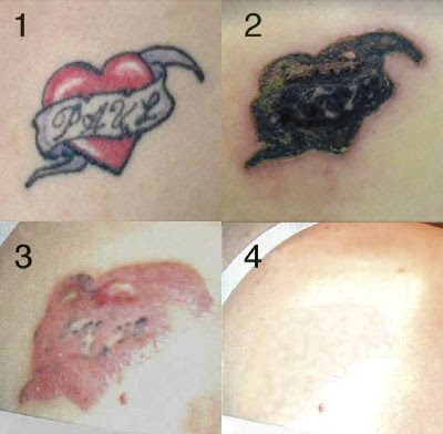 Removing Tattoos