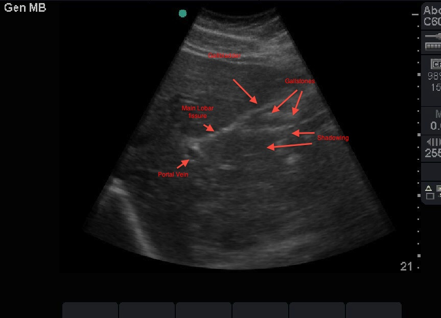 Porcelain Gallbladder Ultrasound Cases Info