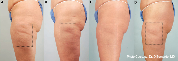 What Is Cellulite Fat In Hindi