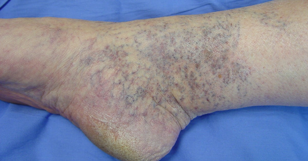 vascular ( blood vessels) Corona Phlebectatica