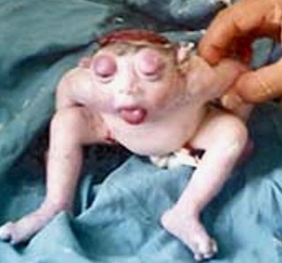 Anencephaly+Stories Hie Post: Frog Like Baby Photos "Woman Gives Birth After 13 Months"