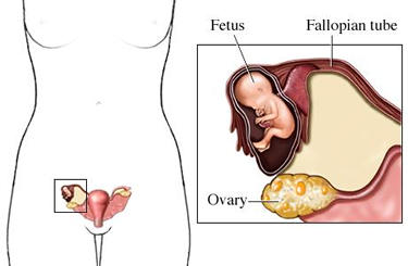 Clomid And Miscarriage