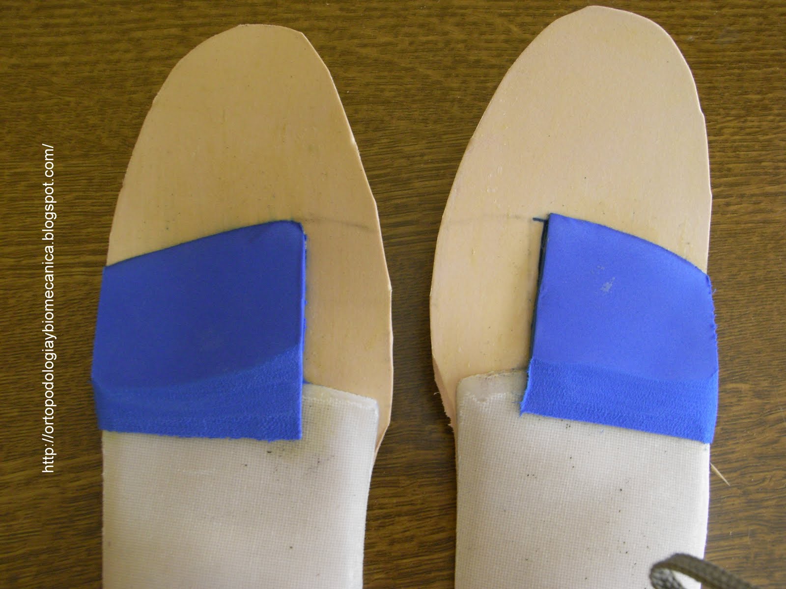 Ortopodologia y Biomecanica HALLUX LIMITUS FUNCIONAL Y WEDGE