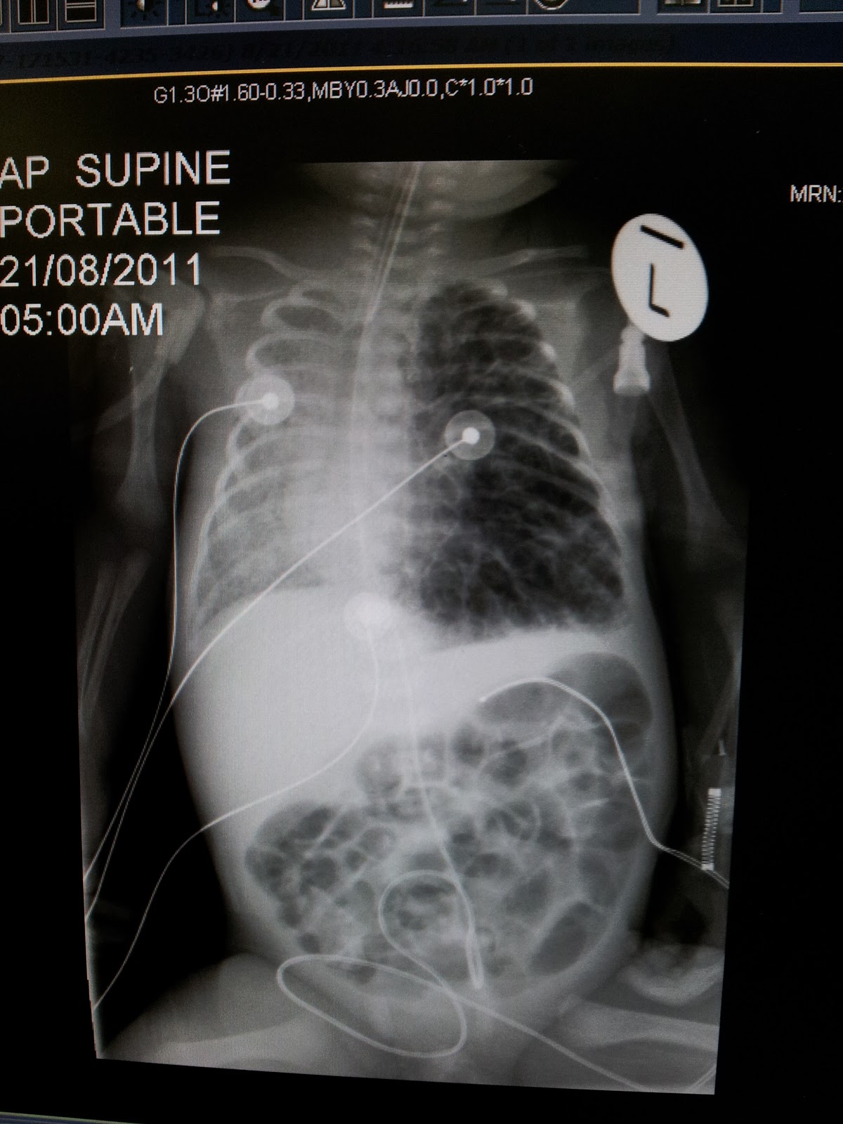 TinyTabitha Day 39 & looking back at the lungs (week 2)
