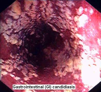 La fase inicial de la psoriasis que hacer