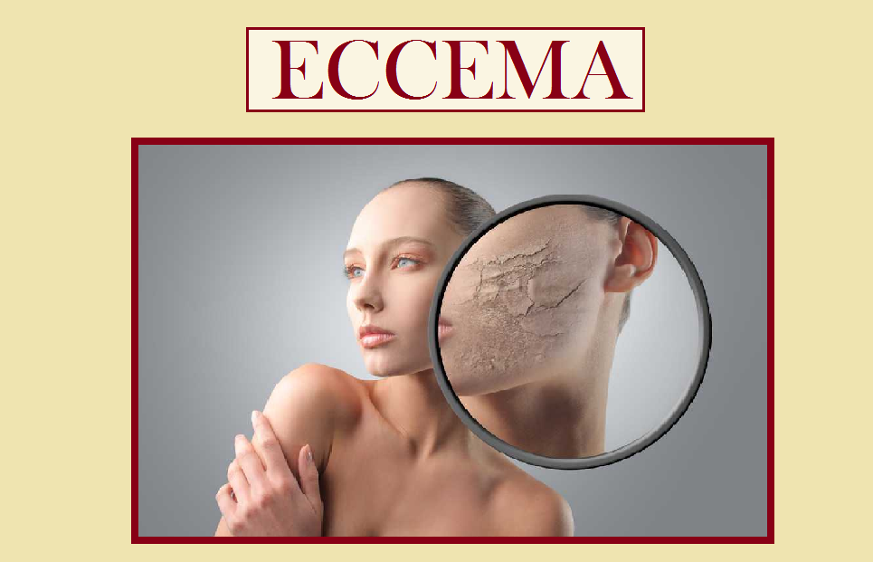 Los nuevos ungüentos a la eccema