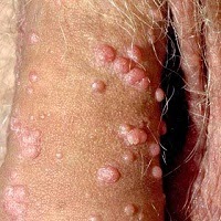 Obat Antibiotik Kutil Kelamin Pria Obat Antibiotik Kutil Kelamin Pria